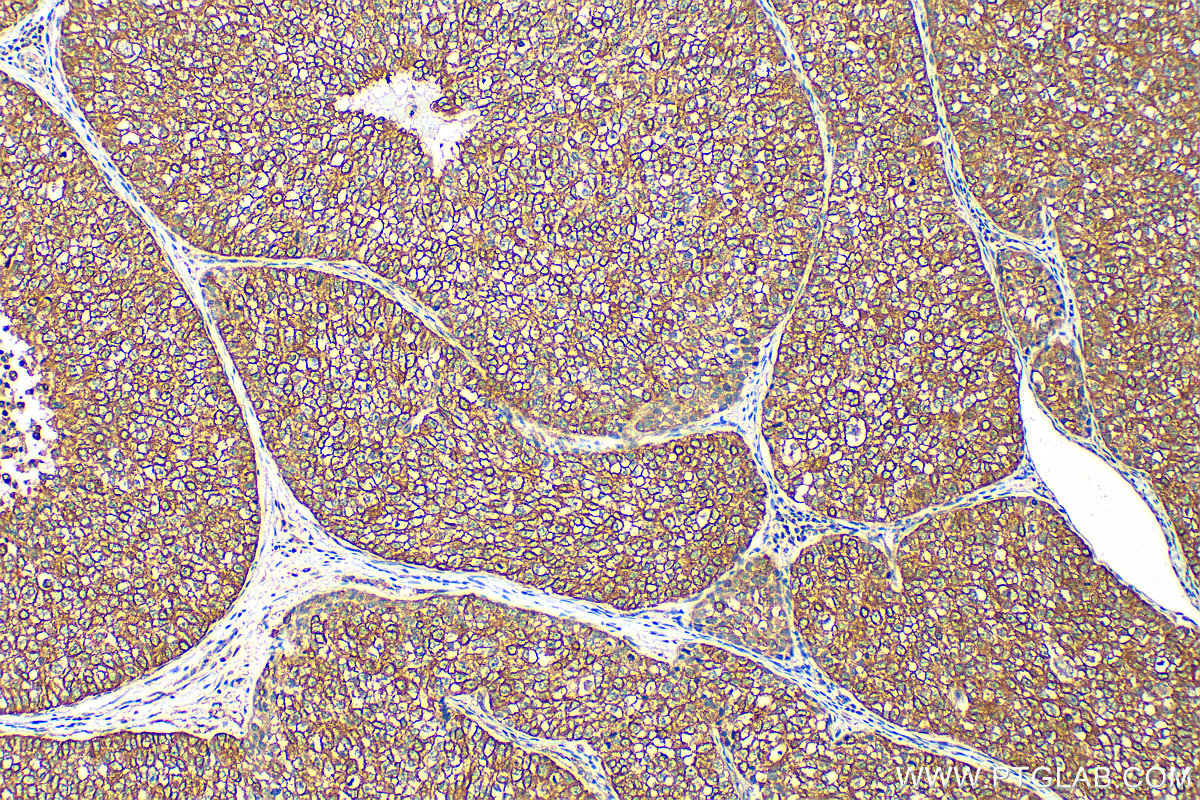 IHC staining of human breast cancer using 23501-1-AP IHC staining of human breast cancer using 23501-1-AP