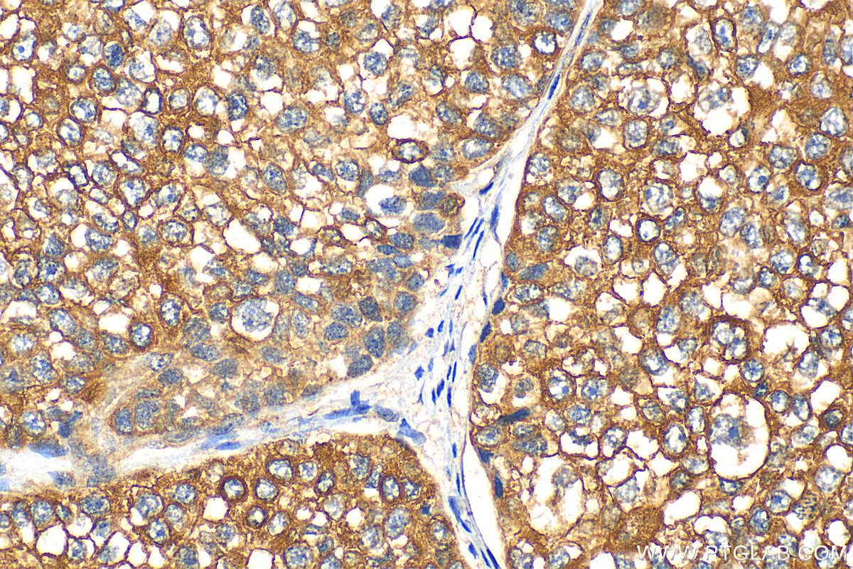 IHC staining of human breast cancer using 23501-1-AP