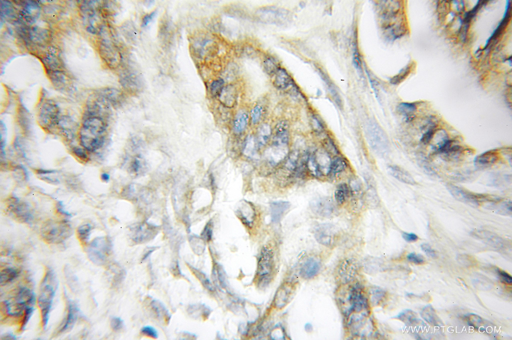 IHC staining of human pancreas cancer using 11579-1-AP