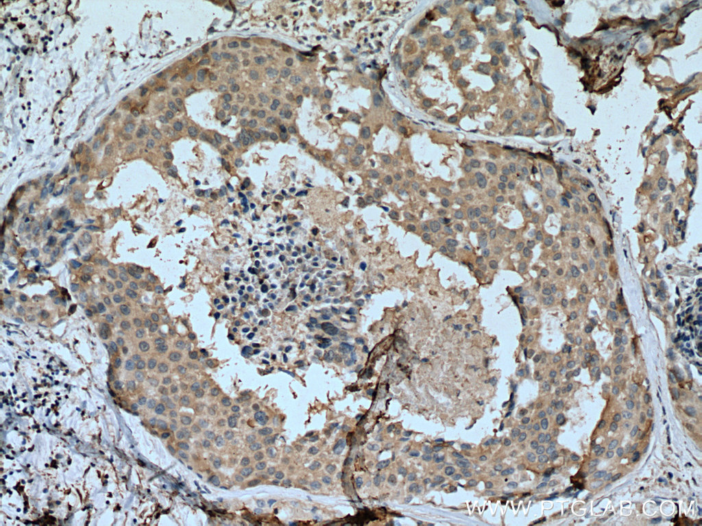 IHC staining of human breast cancer using 67606-1-Ig (same clone as 67606-1-PBS)