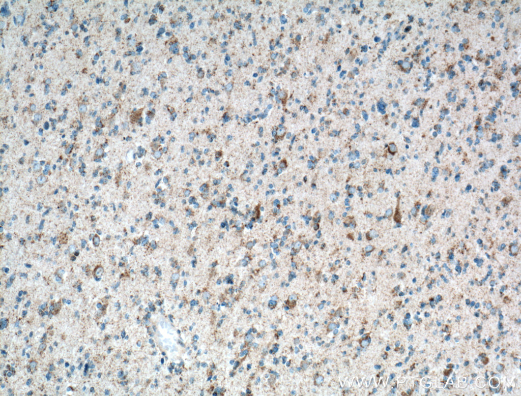 IHC staining of human gliomas using 12175-1-AP