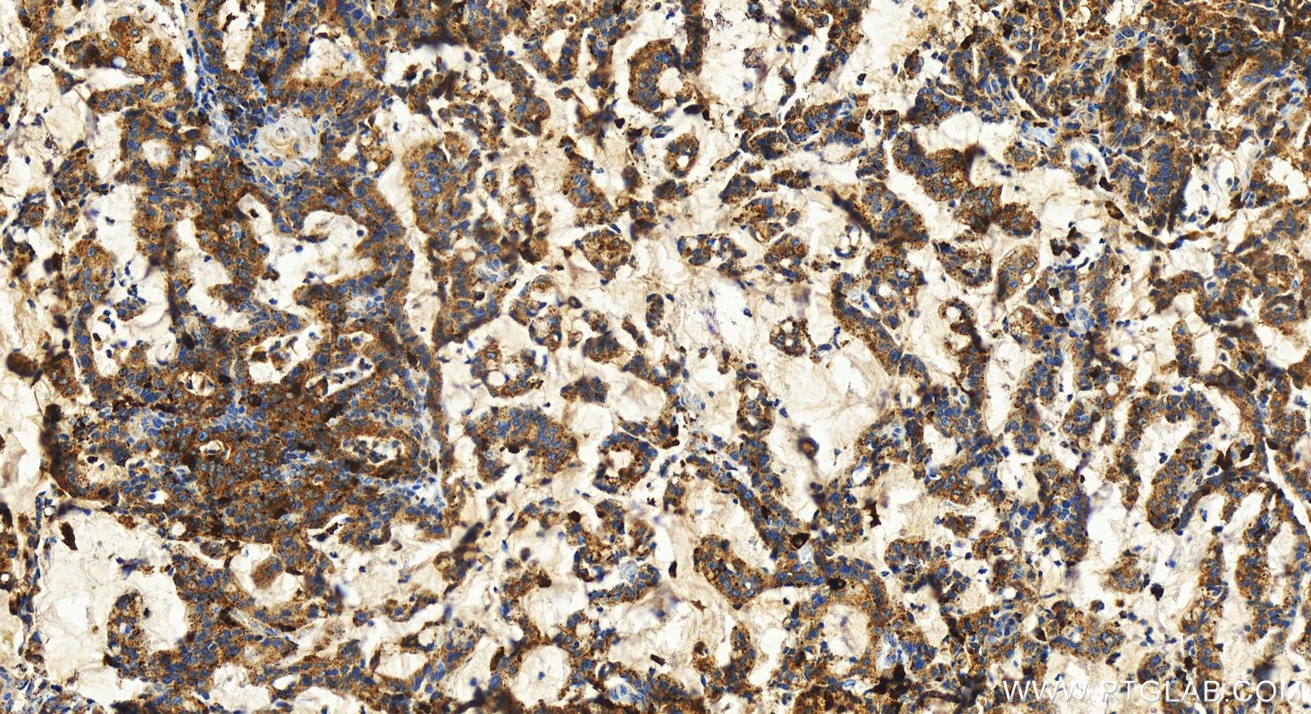 IHC staining of human stomach cancer using 83786-4-RR