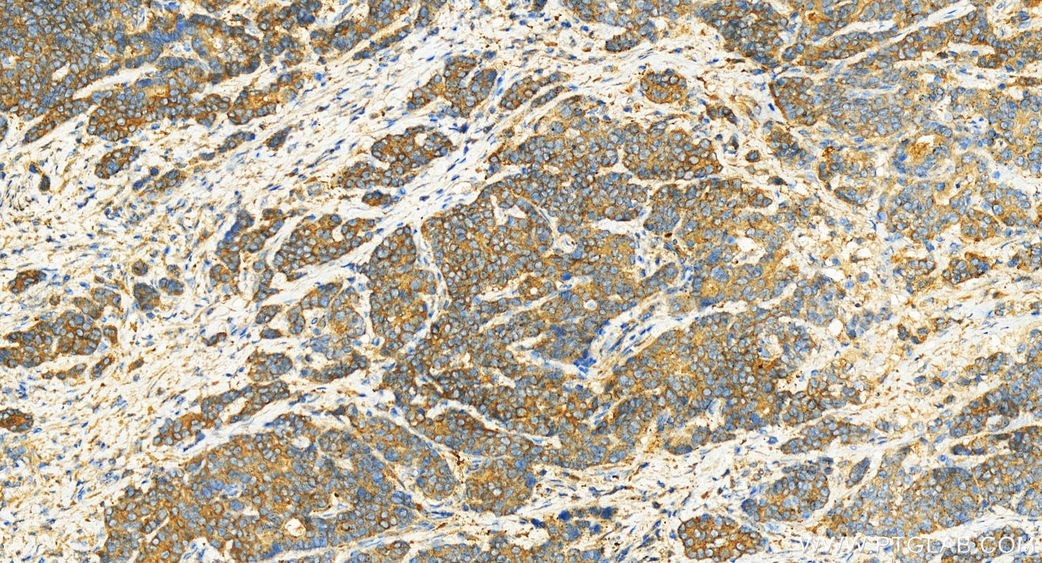 IHC staining of human stomach cancer using 14303-1-AP