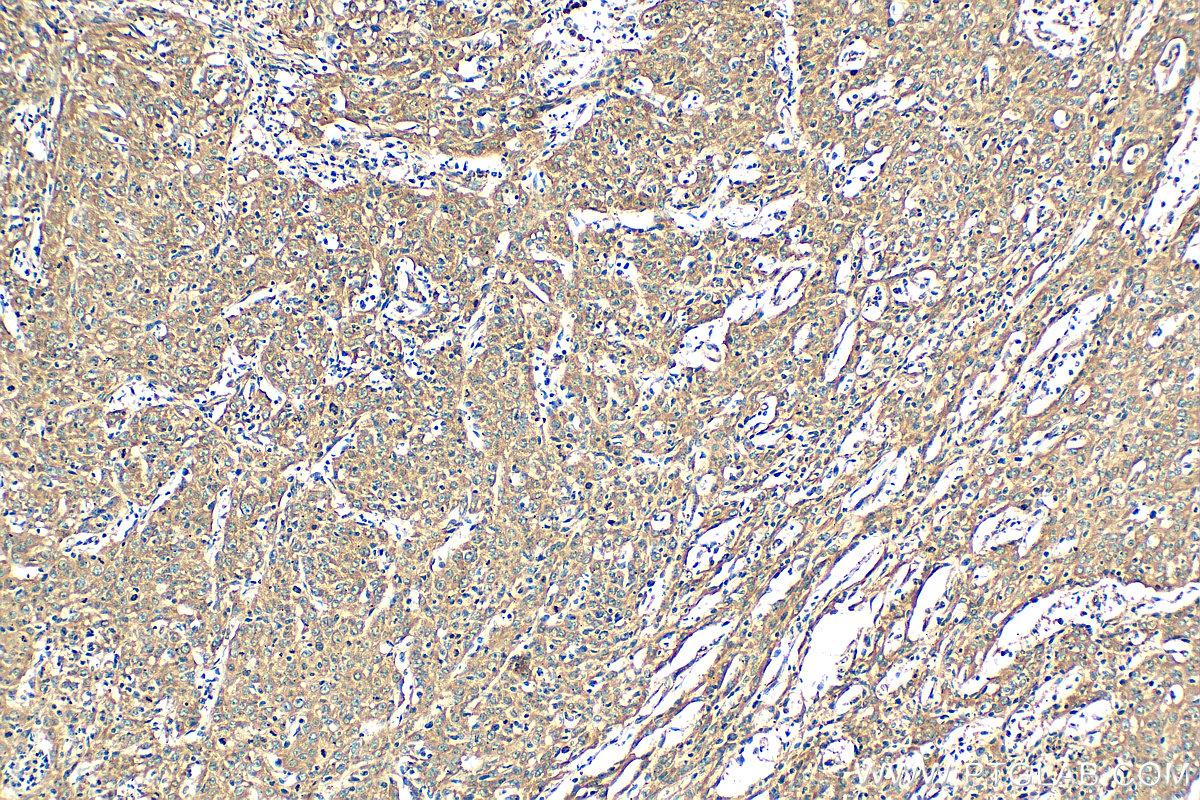 IHC staining of human cervical cancer using 11091-1-AP