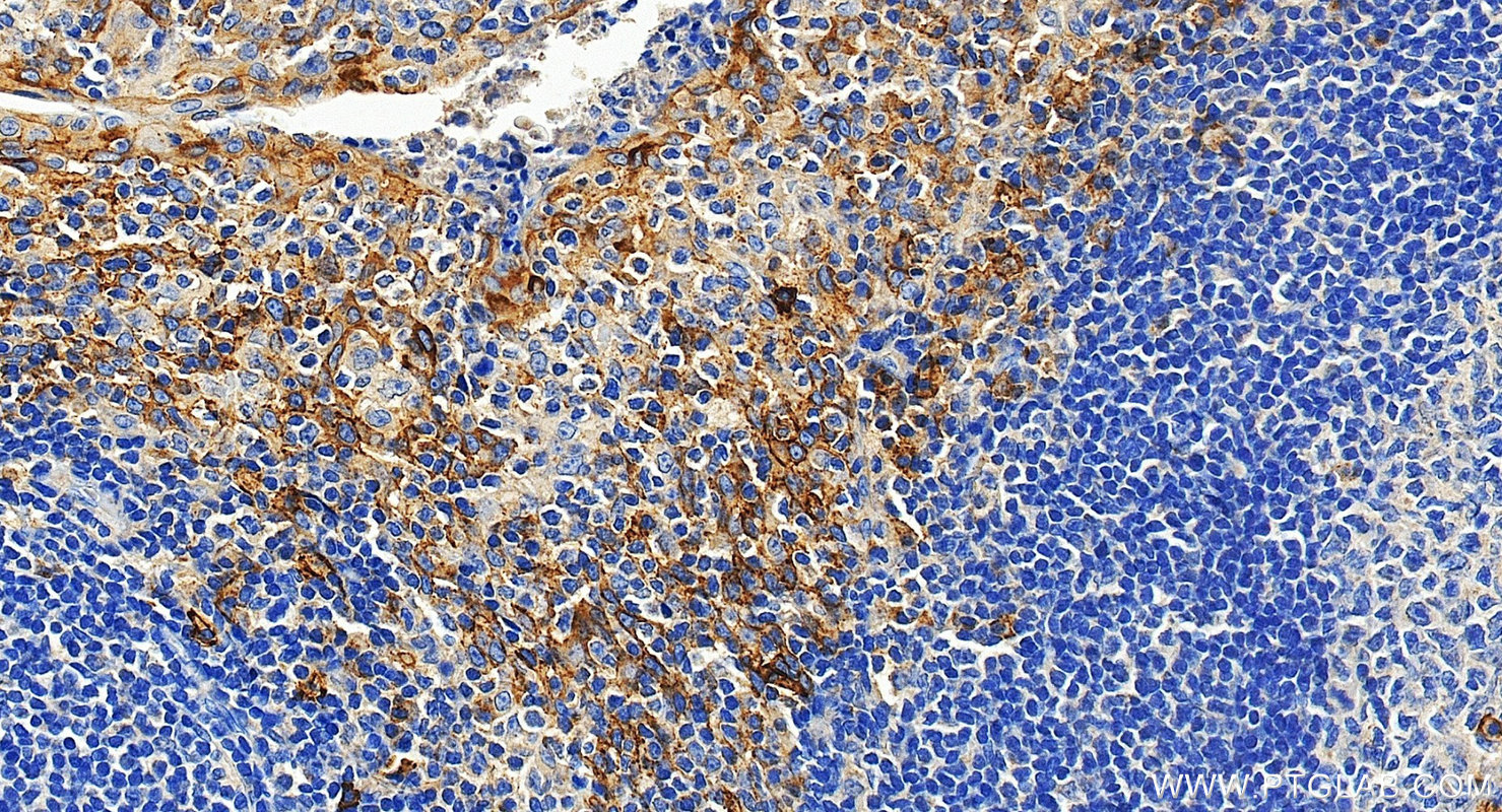 IHC staining of human tonsillitis using 10593-1-AP IHC staining of human tonsillitis using 10593-1-AP