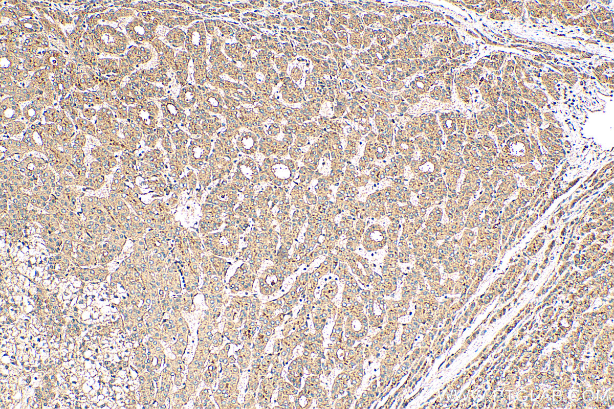 IHC staining of human liver cancer using 22399-1-AP