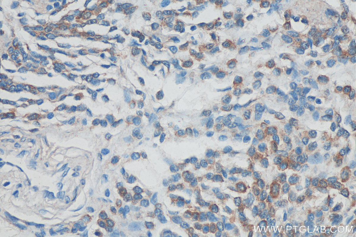 IHC staining of human malignant melanoma using 68096-1-Ig