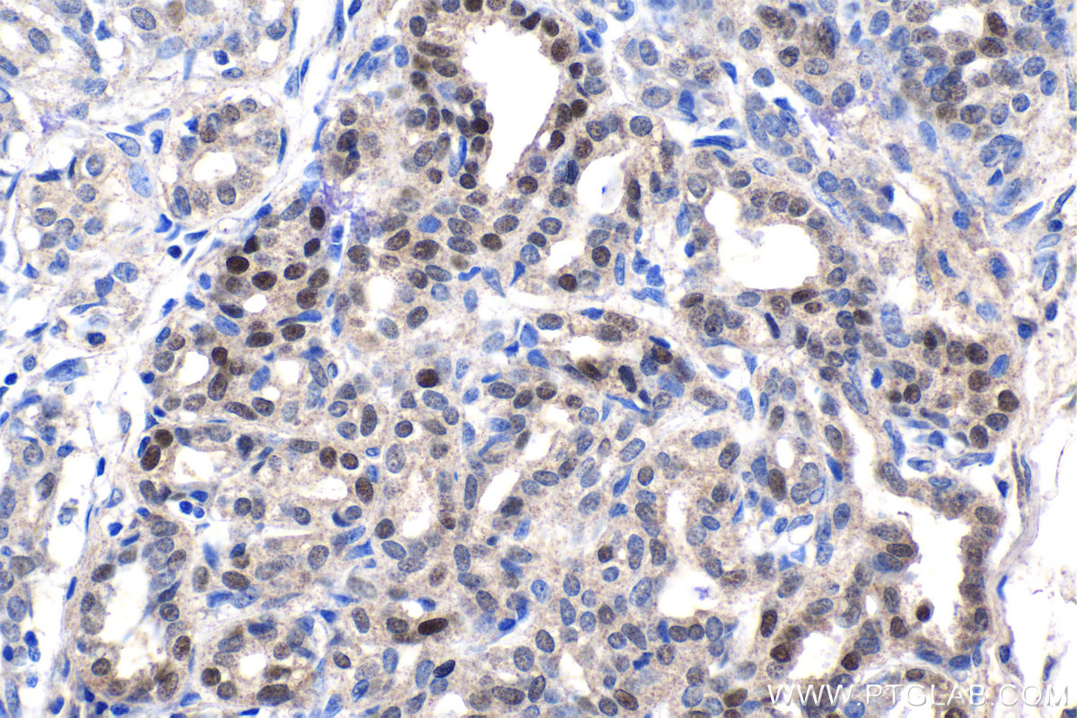 IHC staining of human breast cancer using 10407-1-AP