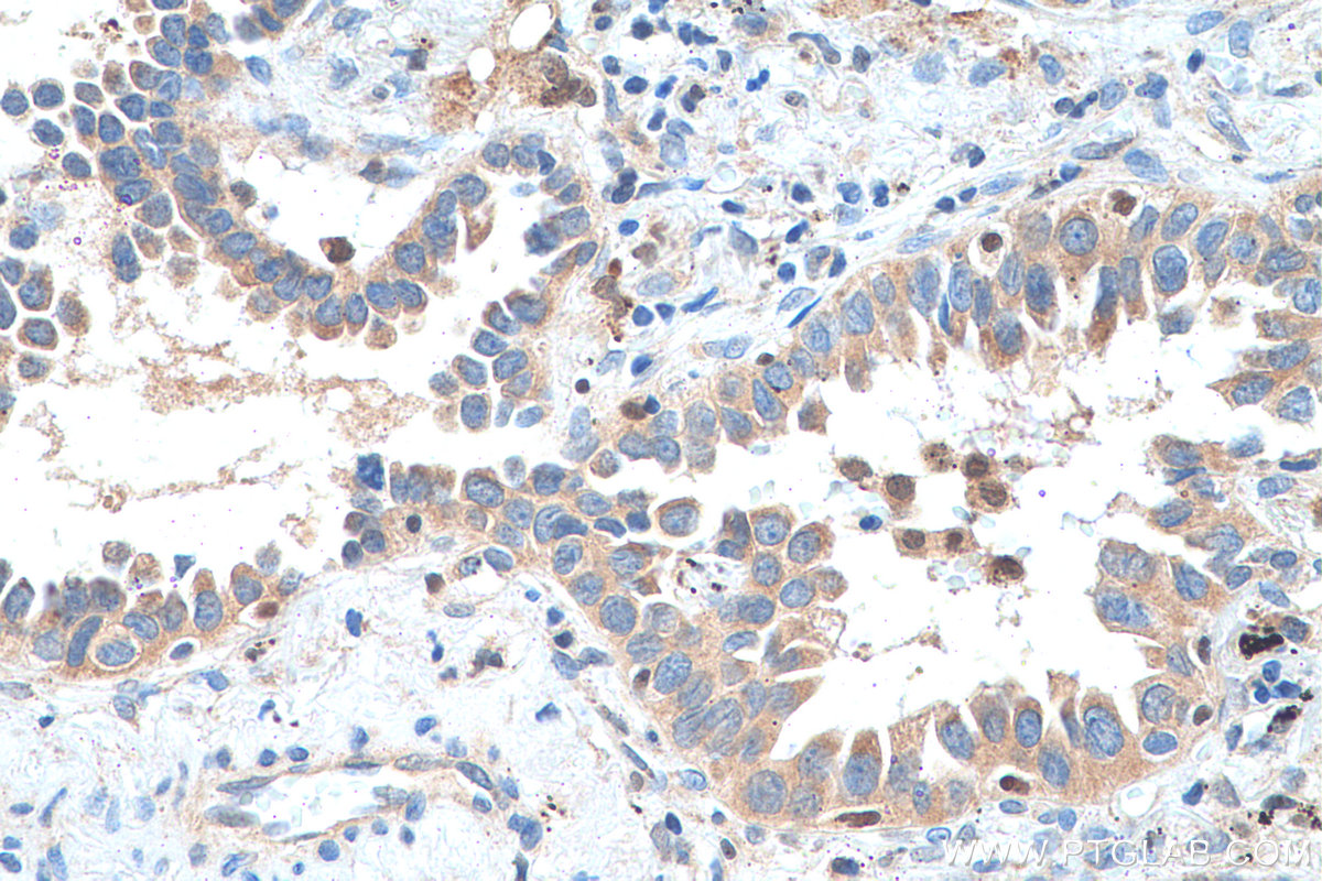 IHC staining of human lung cancer using 11840-1-AP
