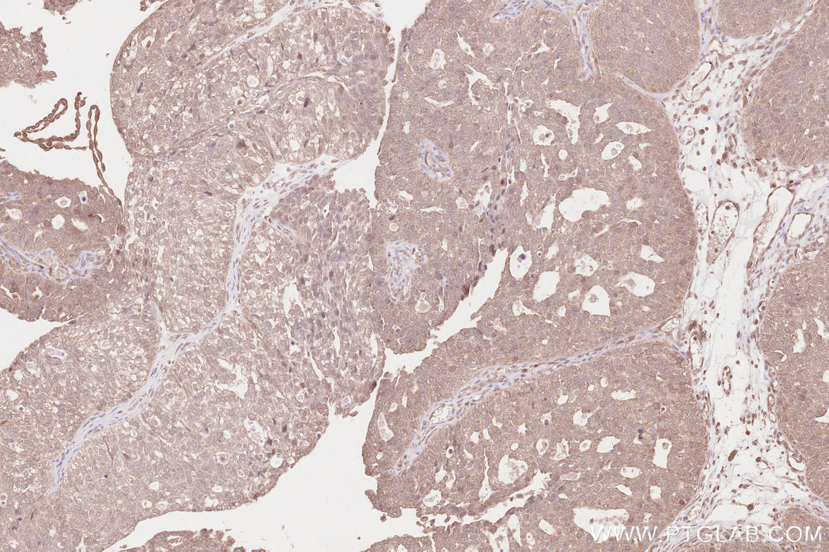 IHC staining of human ovary cancer using 13471-1-AP IHC staining of human ovary cancer using 13471-1-AP
