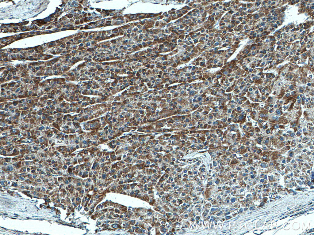 IHC staining of human liver cancer using 66588-1-Ig (same clone as 66588-1-PBS)