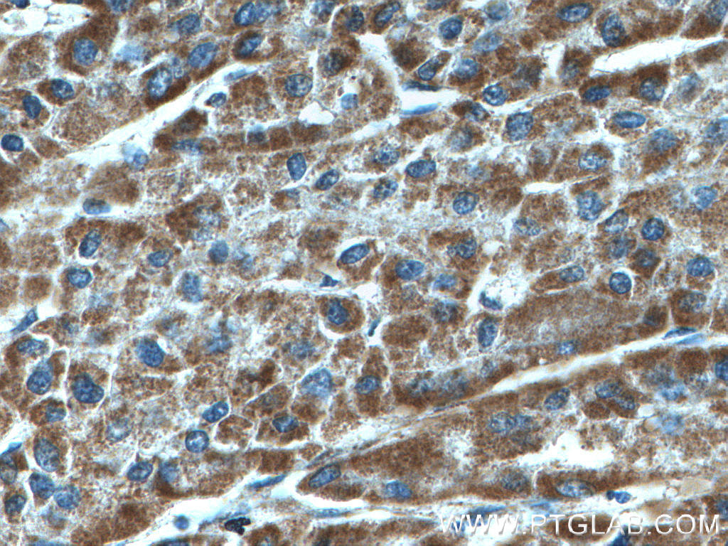 IHC staining of human liver cancer using 66588-1-Ig (same clone as 66588-1-PBS)