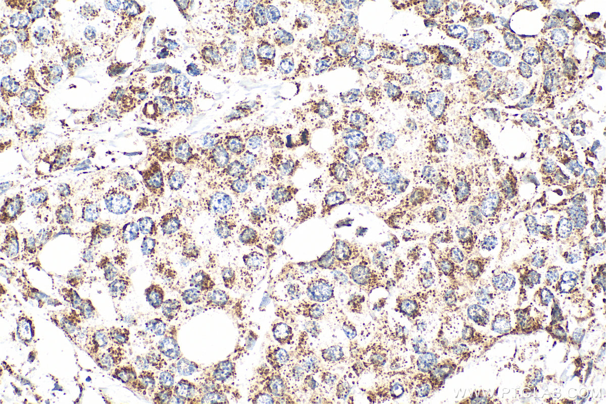 Immunohistochemical analysis of paraffin-embedded human breast cancer tissue slide using 30663-1-AP (C6orf57 antibody) at dilution of 1:200 (under 40x lens). Heat mediated antigen retrieval with Tris-EDTA buffer (pH 9.0). IHC staining of human breast cancer using 30663-1-AP