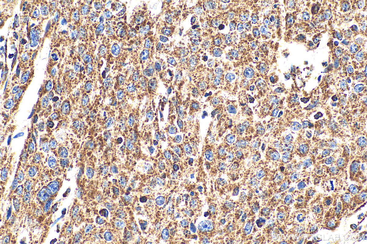 Immunohistochemical analysis of paraffin-embedded human cervical cancer tissue slide using 30663-1-AP (C6orf57 antibody) at dilution of 1:200 (under 40x lens). Heat mediated antigen retrieval with Tris-EDTA buffer (pH 9.0). IHC staining of human cervical cancer using 30663-1-AP