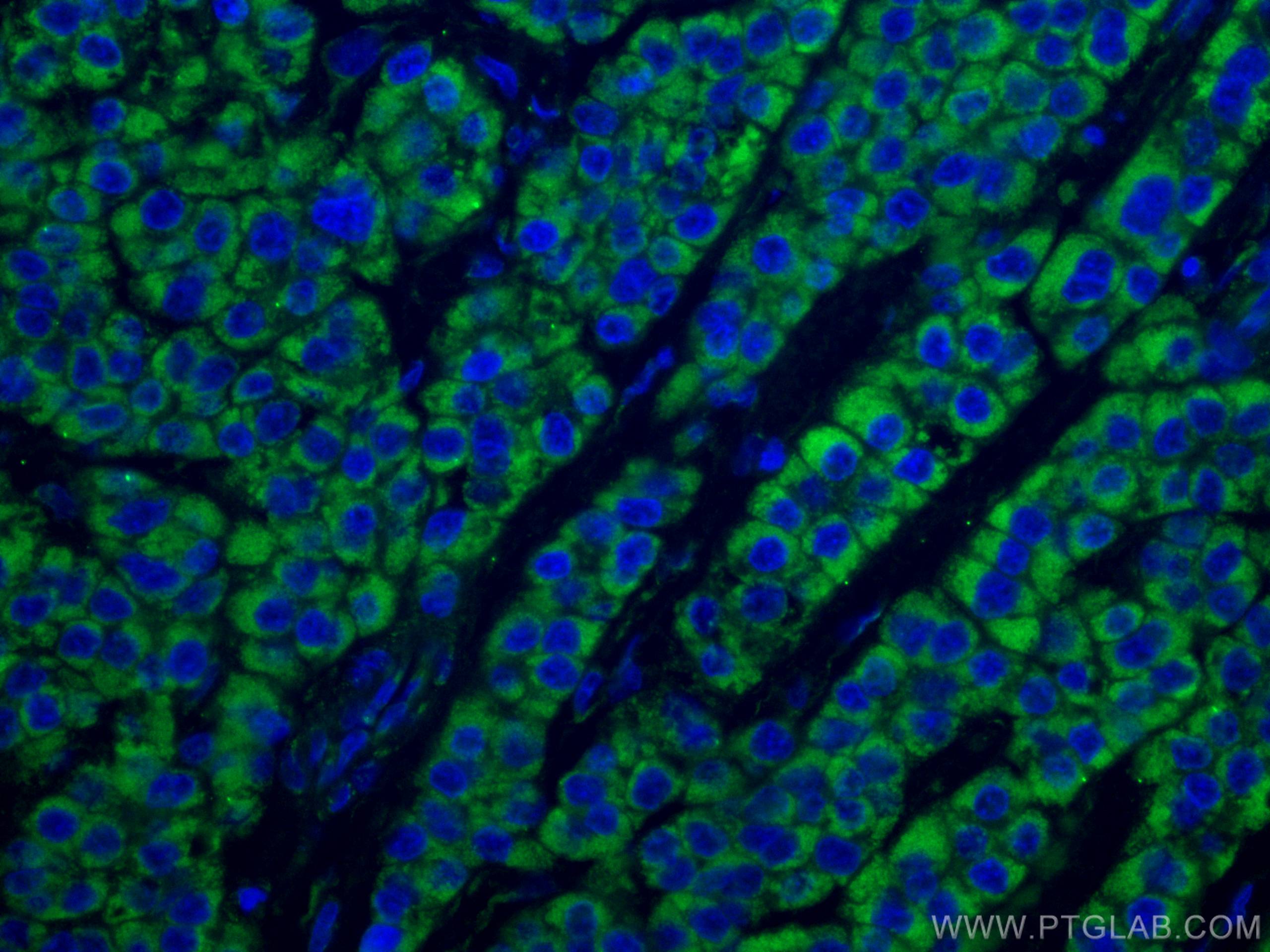 IF Staining of human liver cancer using CL488-67600