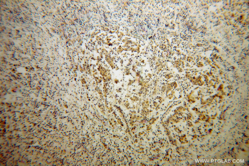 IHC staining of human breast cancer using 14575-1-AP