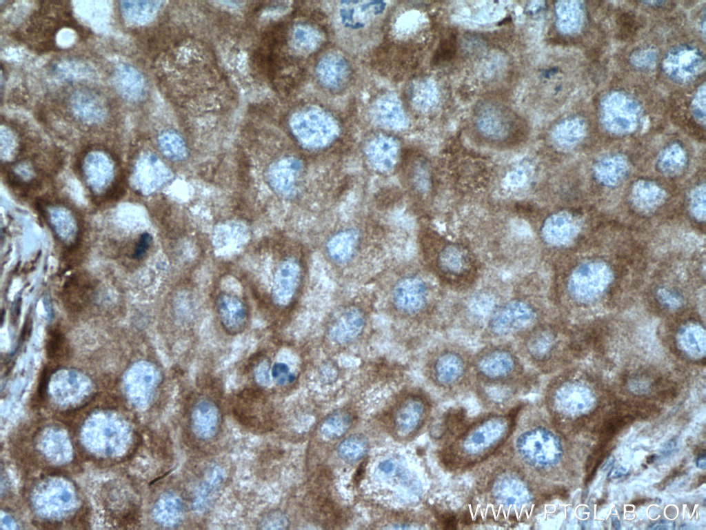 IHC staining of human breast cancer using 14776-1-AP