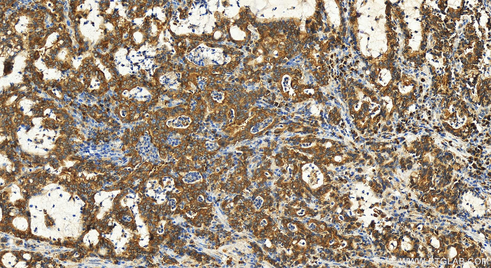 IHC staining of human stomach cancer using 30510-1-AP