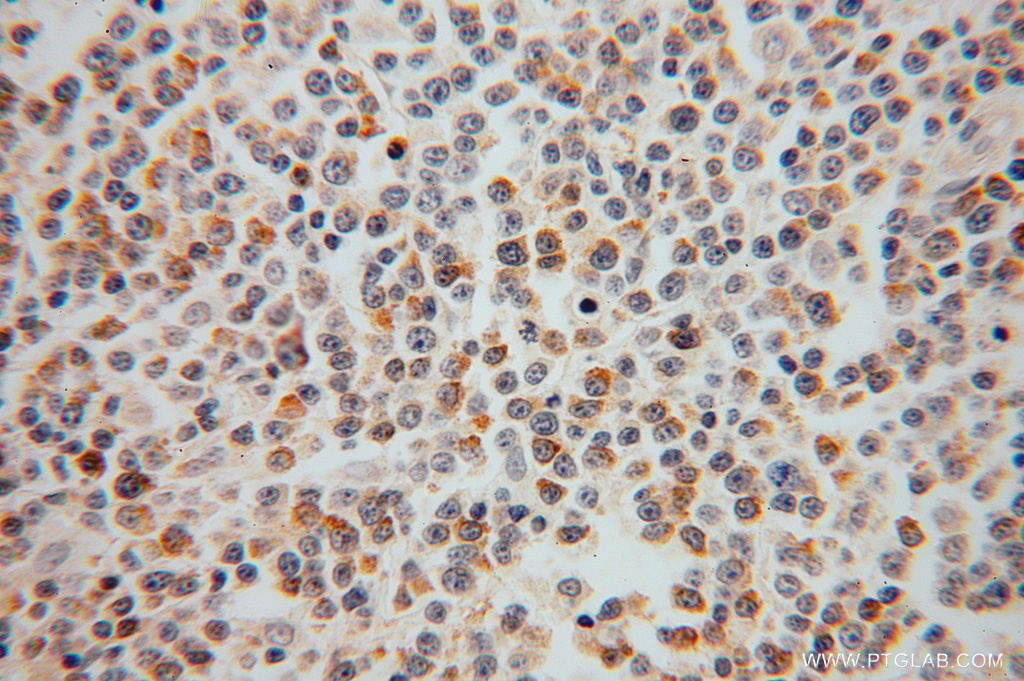 IHC staining of human lymphoma using 15958-1-AP