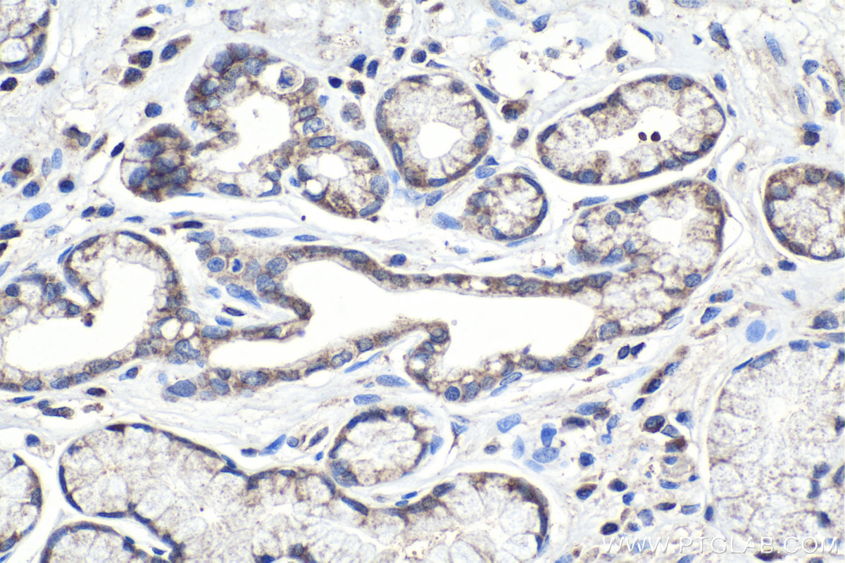 IHC staining of human stomach cancer using 16073-1-AP