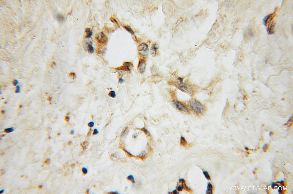 IHC staining of human breast cancer using 12751-1-AP