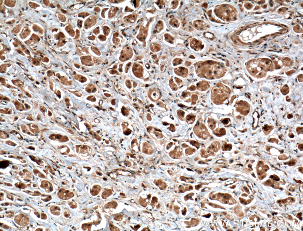 IHC staining of human breast cancer using 66011-1-Ig