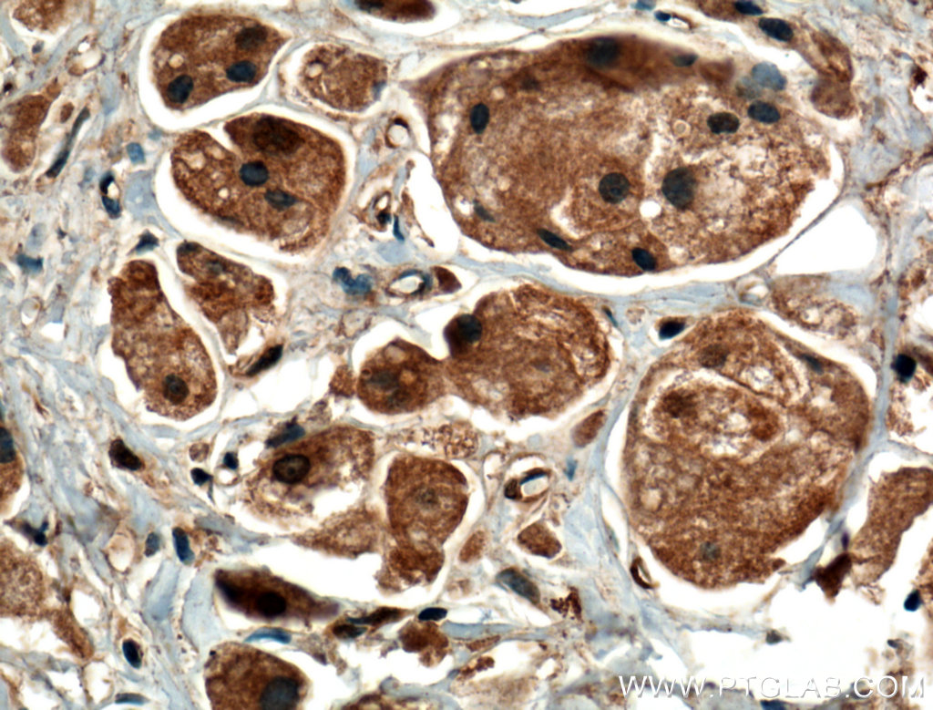 IHC staining of human breast cancer using 66011-1-Ig