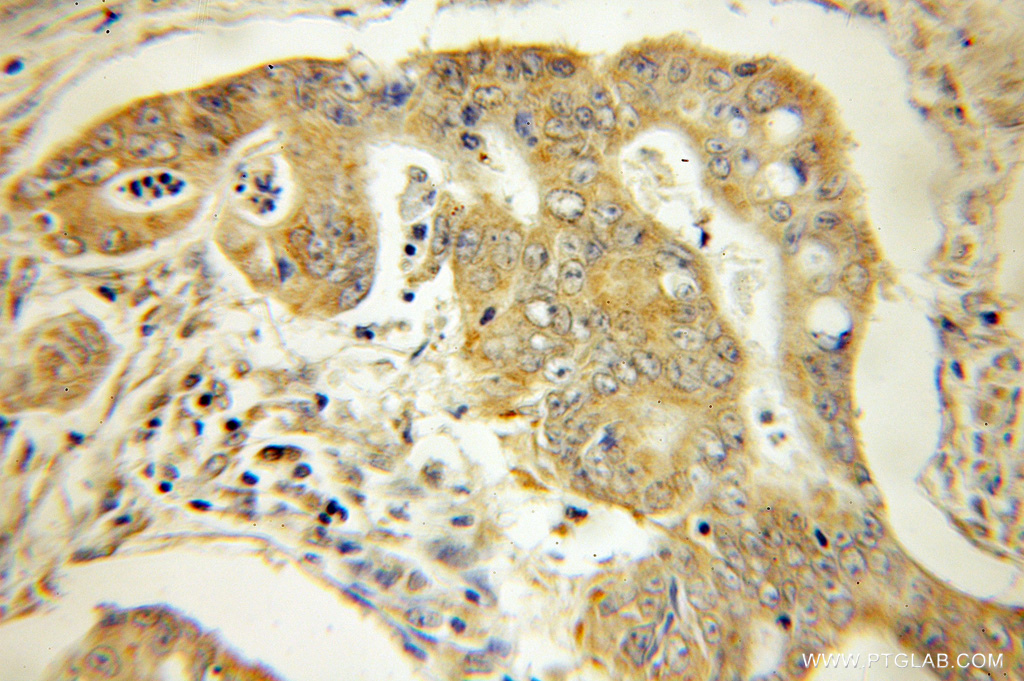 IHC staining of human colon cancer using 11147-2-AP
