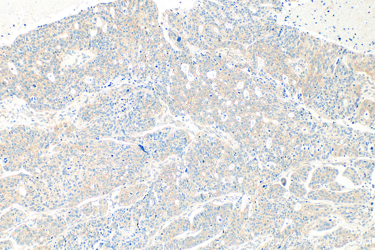 IHC staining of human ovary tumor using 28693-1-AP