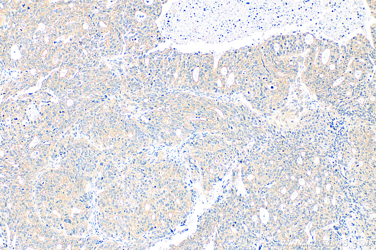 IHC staining of human ovary tumor using 28693-1-AP
