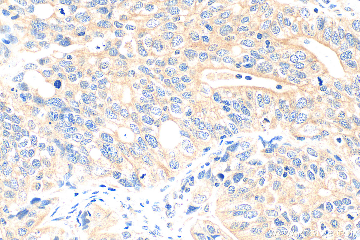 IHC staining of human ovary tumor using 28693-1-AP