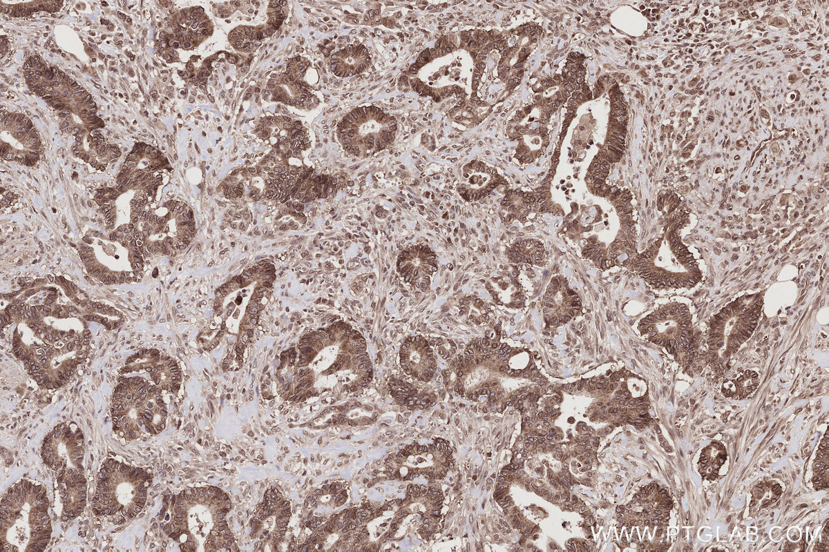 IHC staining of human rectal cancer using 15565-1-AP (same clone as 15565-1-PBS) IHC staining of human rectal cancer using 15565-1-AP (same clone as 15565-1-PBS)