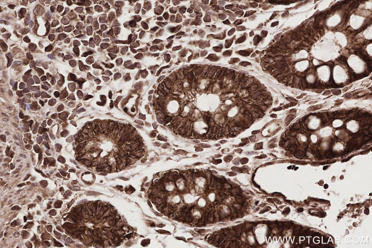 IHC staining of human rectal cancer using 15565-1-AP (same clone as 15565-1-PBS) IHC staining of human rectal cancer using 15565-1-AP (same clone as 15565-1-PBS)