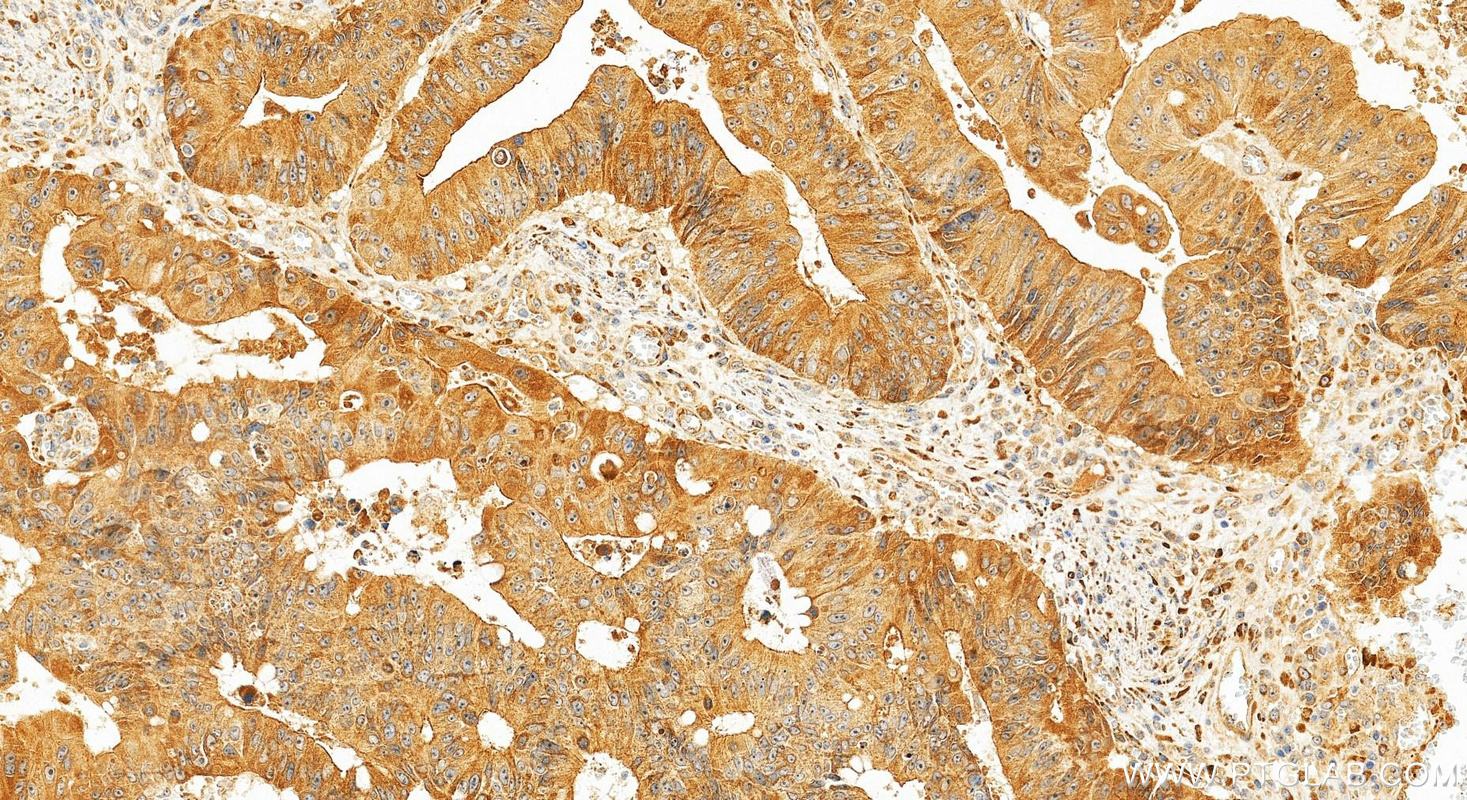IHC staining of human colon cancer using 31489-1-AP (same clone as 31489-1-PBS) IHC staining of human colon cancer using 31489-1-AP (same clone as 31489-1-PBS)