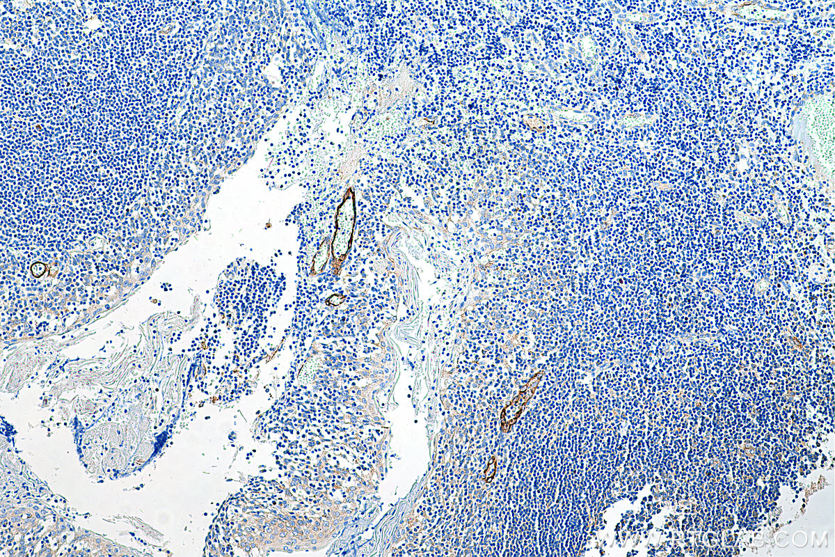 IHC staining of human tonsillitis using 20894-1-AP