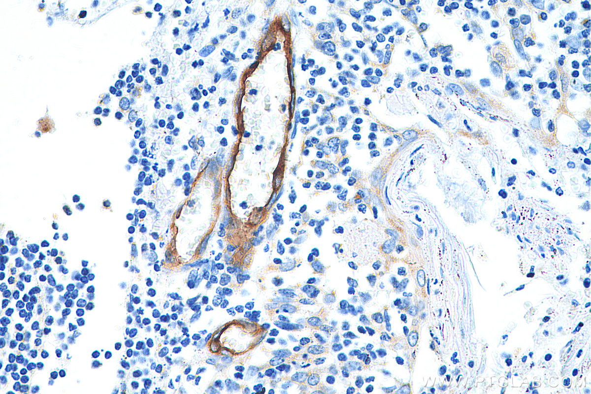 IHC staining of human tonsillitis using 20894-1-AP