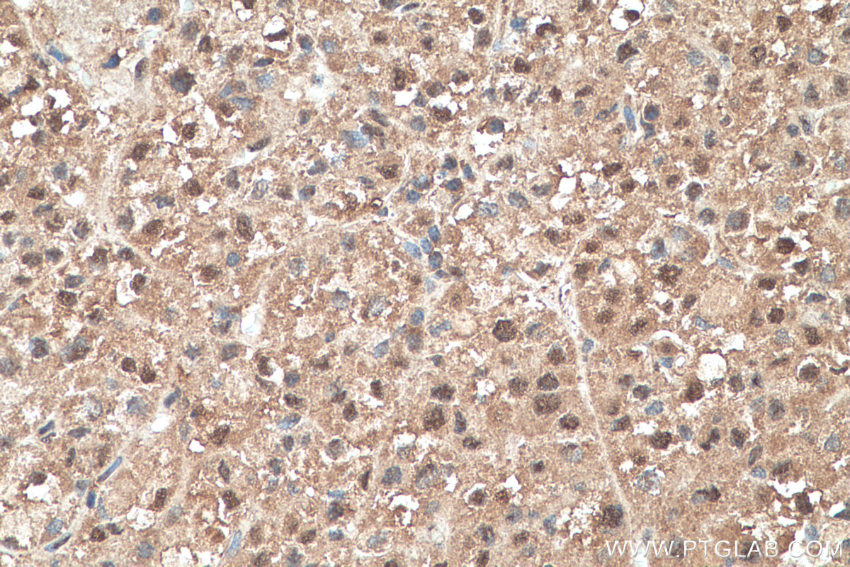 IHC staining of human liver cancer using 27449-1-AP