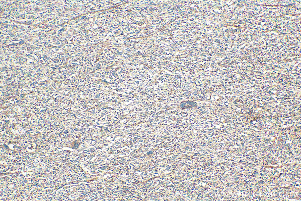 IHC staining of human pancreas cancer using 32860-1-AP (same clone as 32860-1-PBS)