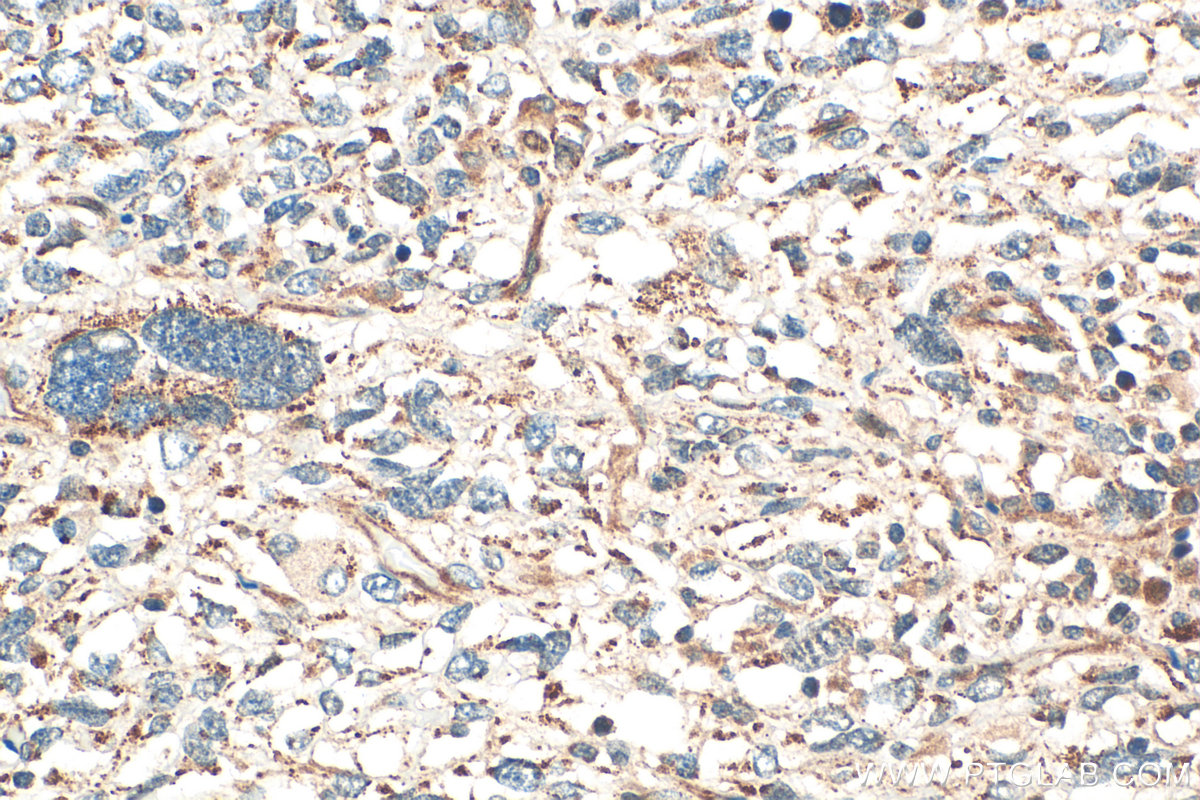 IHC staining of human pancreas cancer using 32860-1-AP (same clone as 32860-1-PBS)