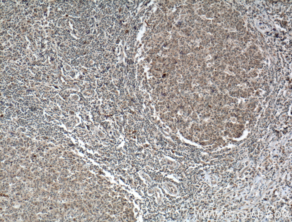 IHC staining of human tonsillitis using 26477-1-AP