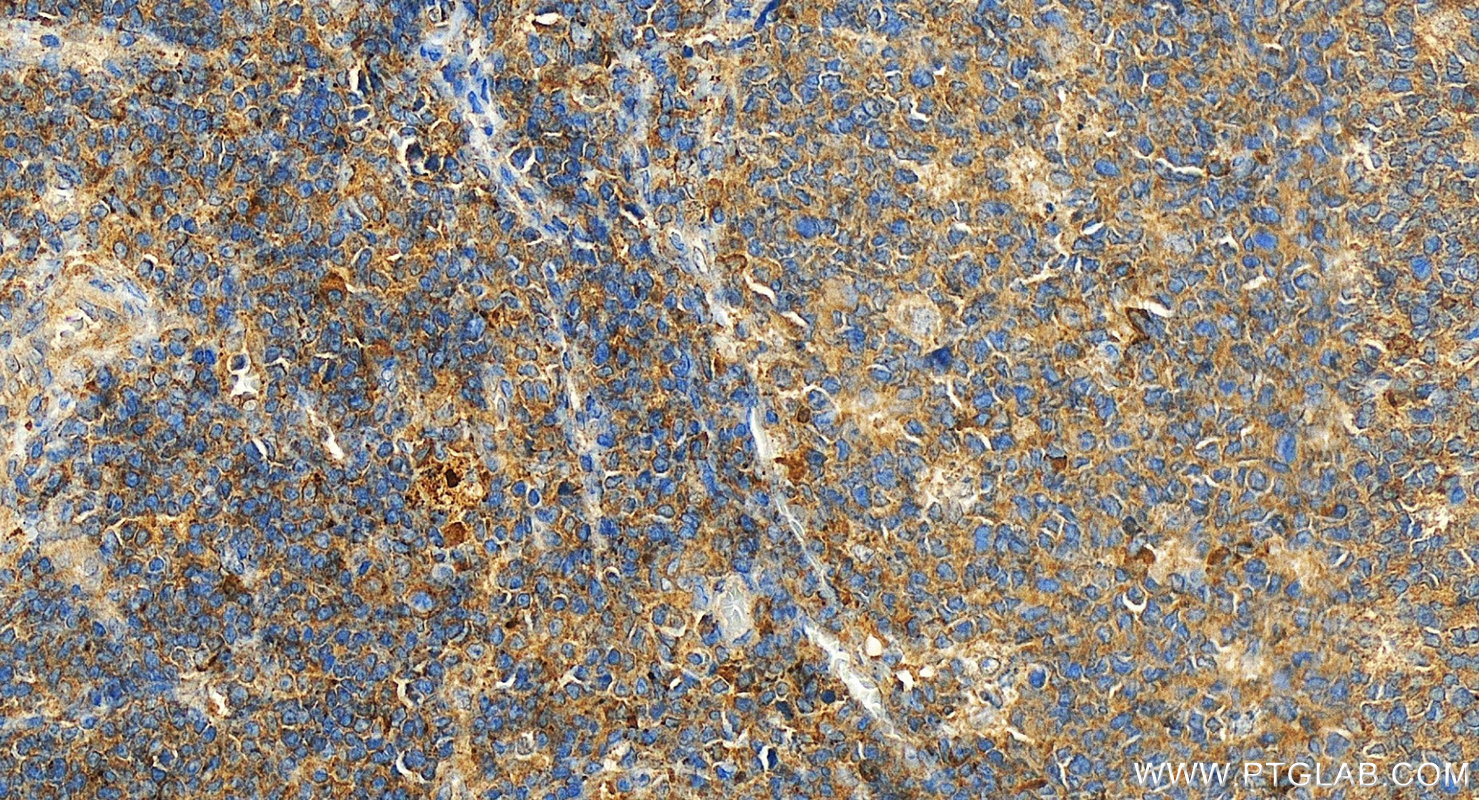 Immunohistochemical analysis of paraffin-embedded human tonsillitis tissue slide using 26477-1-AP (CD62L antibody) at dilution of 1:1000 (under 20x lens). Heat mediated antigen retrieval with Tris-EDTA buffer (pH 9.0). IHC staining of human tonsillitis using 26477-1-AP