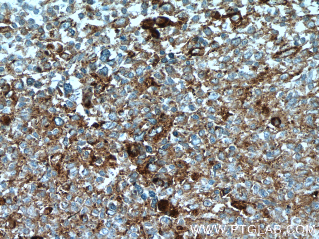 IHC staining of human tonsillitis using 23605-1-AP