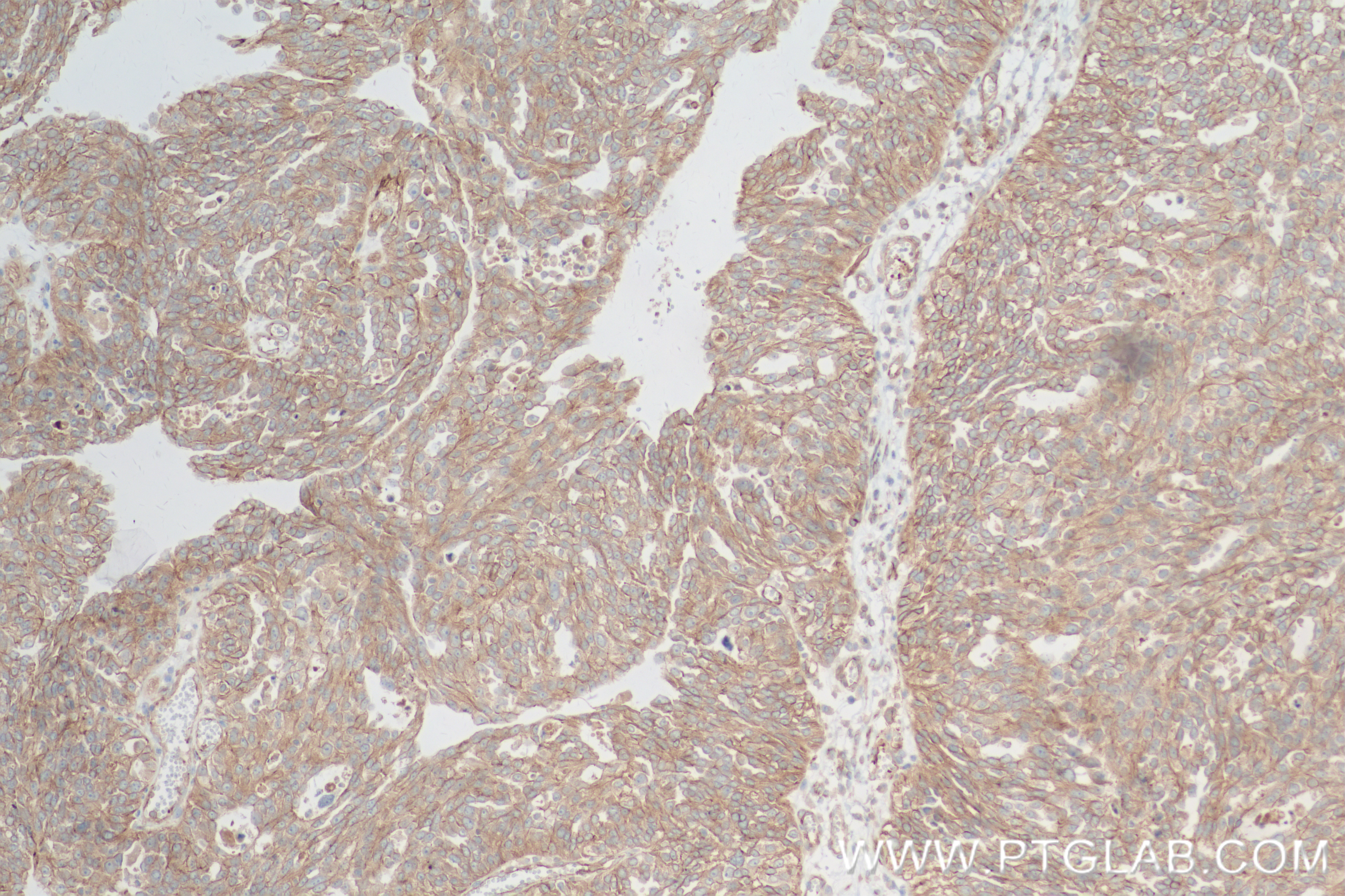 IHC staining of human ovary cancer using 83579-5-RR (same clone as 83579-5-PBS)