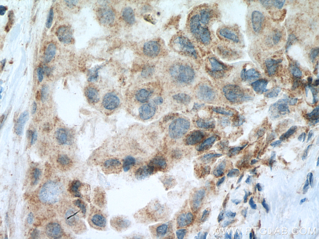 IHC staining of human breast cancer using 27359-1-AP