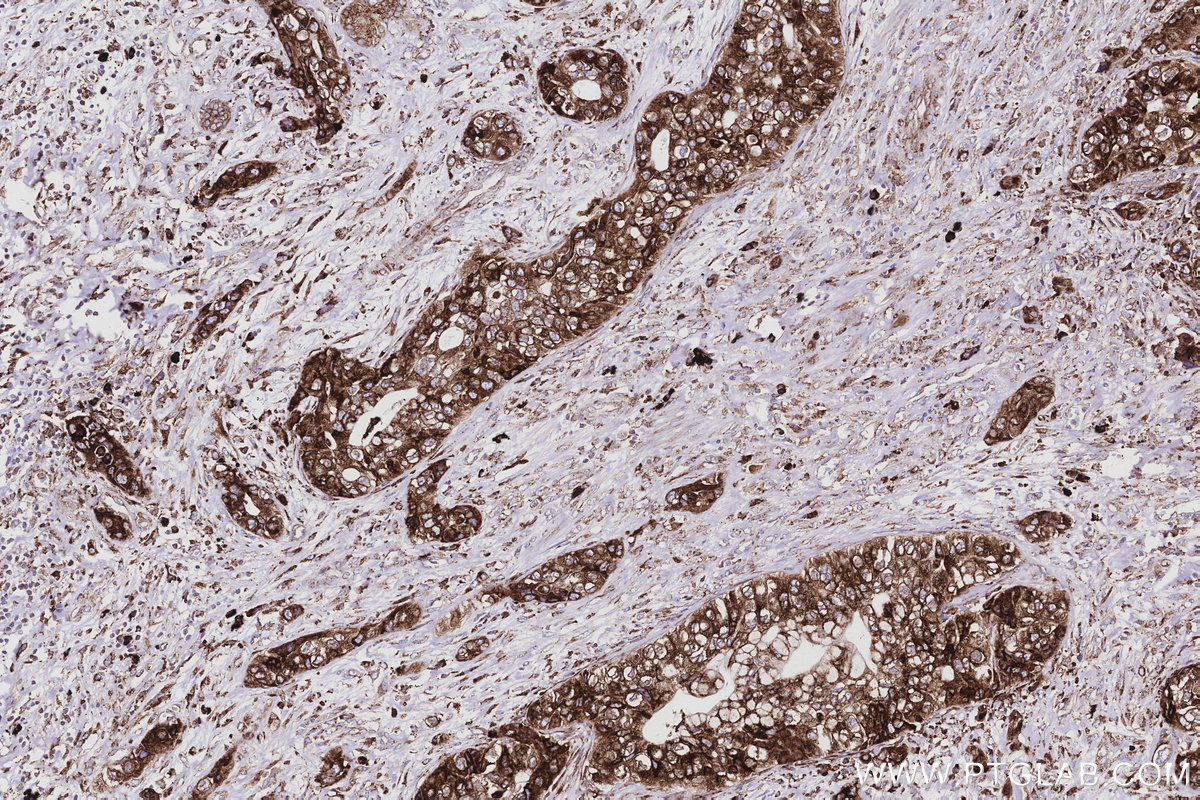 IHC staining of human pancreas cancer using 83594-4-RR