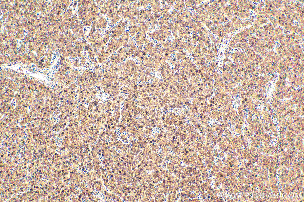 IHC staining of human liver cancer using 14109-1-AP