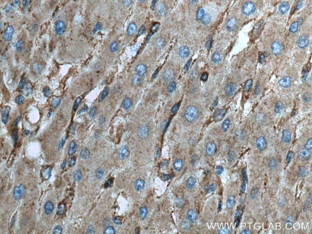 IHC staining of human liver cancer using 11397-1-AP