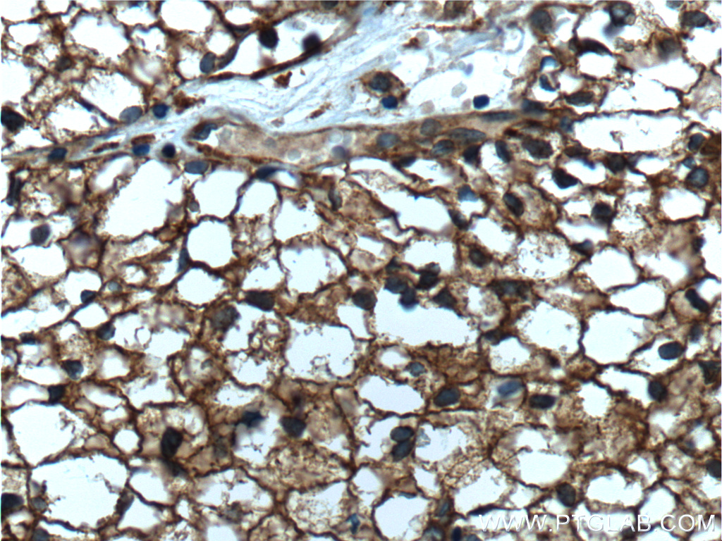 IHC staining of human renal cell carcinoma using 60075-1-Ig