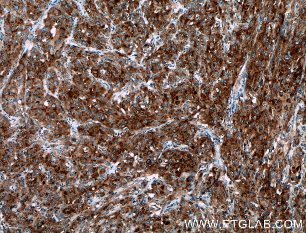 IHC staining of human cervical cancer using 12805-1-AP (same clone as 12805-1-PBS)