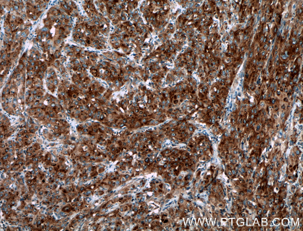 IHC staining of human cervical cancer using 12805-1-AP